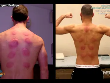 Edu Aguirre se pone en la piel de Benzema: conocemos la 'VENTOSATERAPIA' Edu Aguirre se pone en la piel de Benzema: conocemos la 'VENTOSATERAPIA'